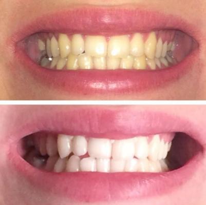 Buy, Sell A Teeth Whitening Studio - No License Required Business